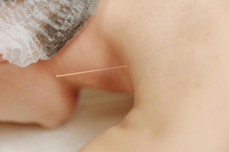 A fine dry needling needle placed in the shoulder area
